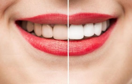 cleaning-and-scaling