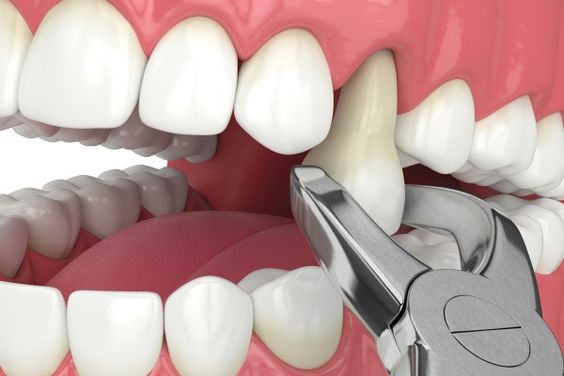 dental-extraction