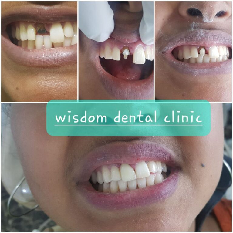 crowns before and after