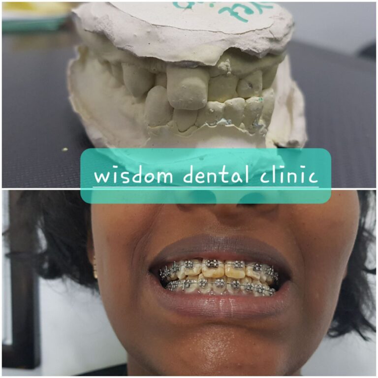 orthodontics before and after