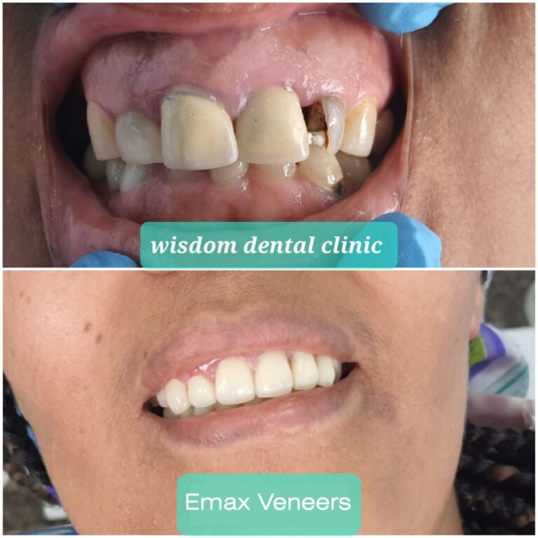 veneers before and after